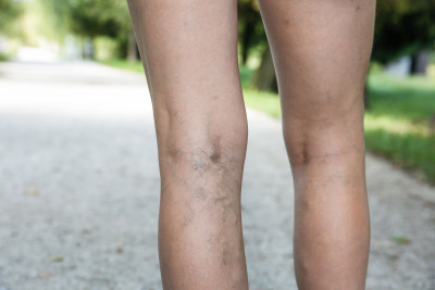 Apa Itu Deep Vein Thrombosis? Kenali Penyakit Bekuan Darah Ini